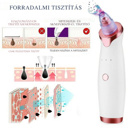 Aknéeltávolító – Hatékony és fájdalommentes tisztítás