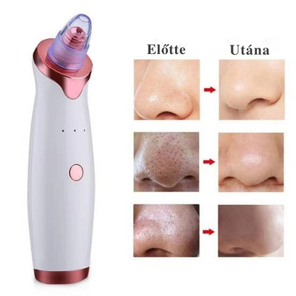 Aknéeltávolító – Hatékony és fájdalommentes tisztítás