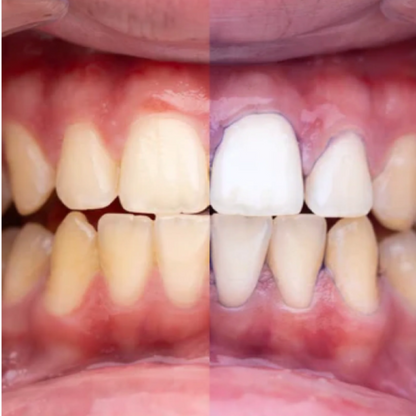 GlumiWhite – V34 Fehérítő – [AKCIÓ CSAK MA ÉRVÉNYES]